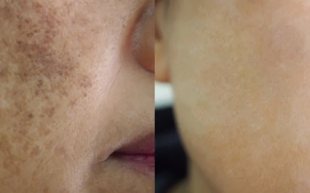 Pigmentation Treatment: The Impact of Hormonal Changes on Skin Pigmentation
