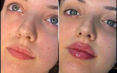 Best Aesthetic Clinic in dubai for Fillers: What to Know About Treatment Recovery