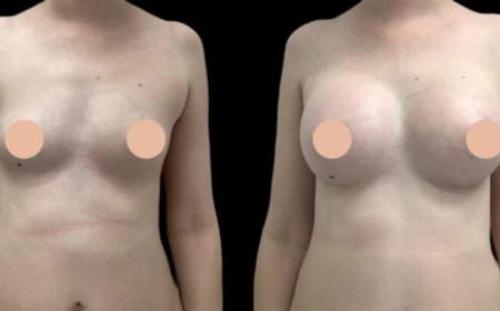 Why Breast Augmentation in Dubai Is in High Demand