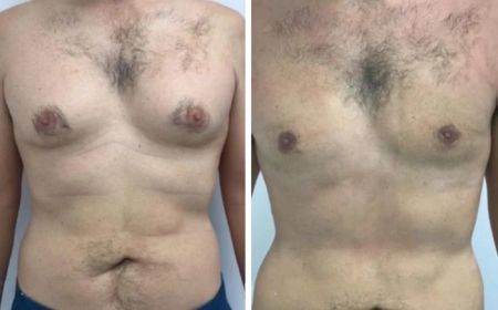 How Gynecomastia in Dubai Can Affect Your Self-Esteem and Confidence