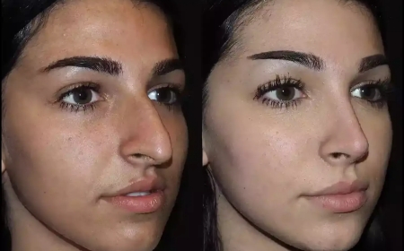 Best Rhinoplasty Procedures in Dubai for a Natural Look
