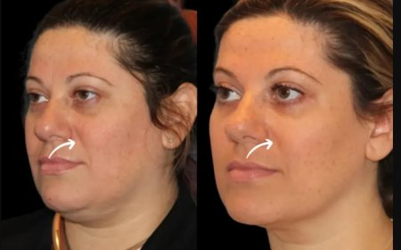 The ‘No Filter’ Look: Best Plastic Surgeons in Dubai Reveal the Power of Sculptra Fillers