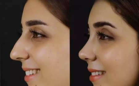 Functional & Aesthetic Results from the Best Septoplasty Surgeons in Dubai