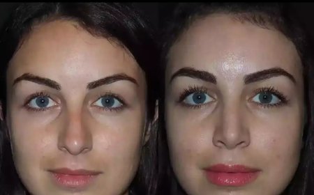 Transform Your Profile with the Best Rhinoplasty Surgeons in Dubai