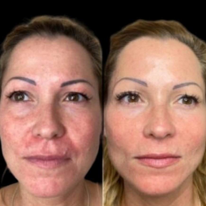 Embrace Vital Skin by Best Doctors in dubai with Profhilo