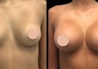 The Top Benefits of Choosing the Best Breast Augmentation Surgeon in Dubai