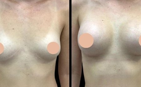 Breast Enlargement Surgery in Dubai: How to Maintain Your Results for Years to Come