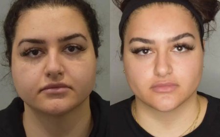 Before and After Care by the Best Buccal fat removal Surgeons in Dubai