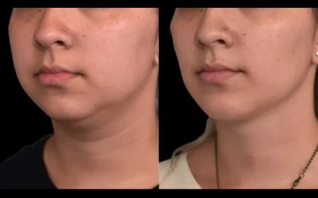 How the Best Double Chin Removal Surgeons in Dubai Can Help You Achieve a Natural-Looking Result