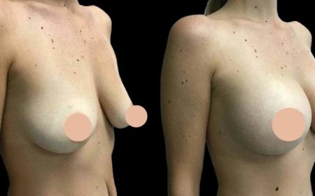 Post-Surgery Care Tips from the Best Doctors in Dubai After Breast Augmentation