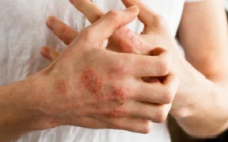 Managing Onchocerciasis with Ivermectin 12mg: What to Know