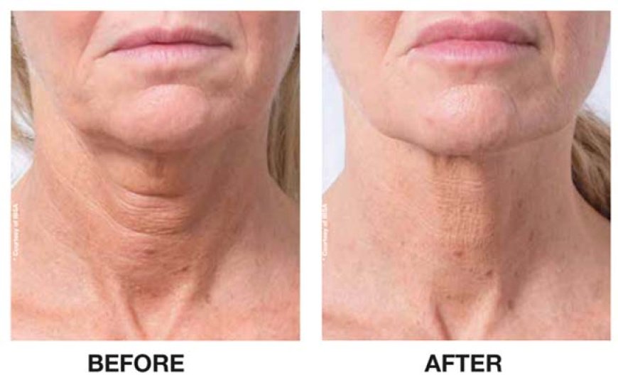 Profhilo Skin Booster Clinic: The Secret to Smooth, Glowing Skin